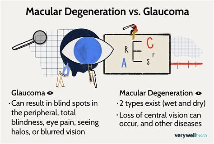 Glaucoma VS. Macular Degeneration - All About Vision