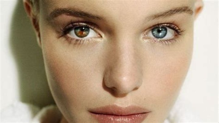 Heterocromía: ojos de distintos colores