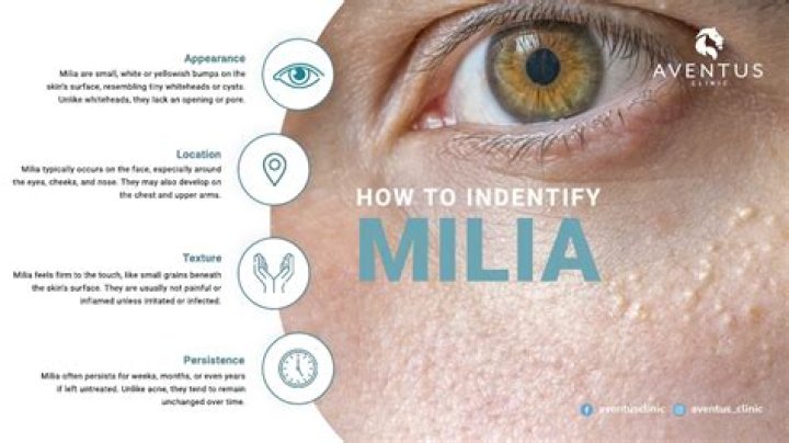 Milia | How to get rid of those white eyelid bumps