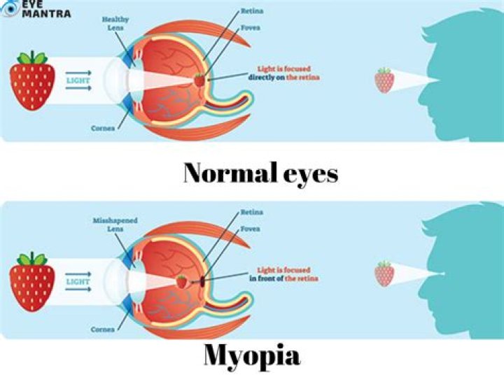 What Causes Myopia (Nearsightedness)?